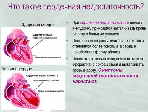 сердечная недостаточность и 6 её ранних сигналов